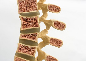 osteoporosis